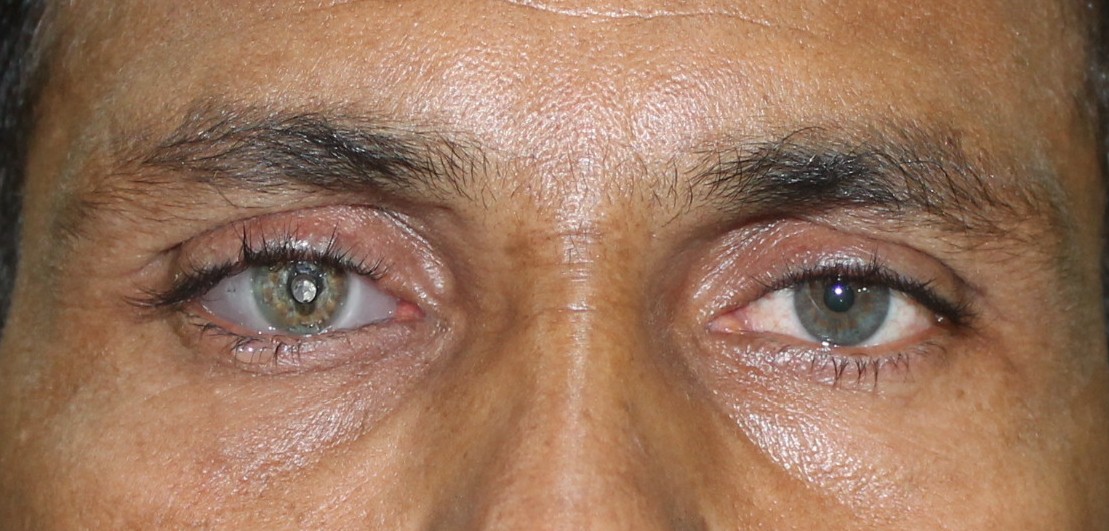 Artificial Eye Delhi